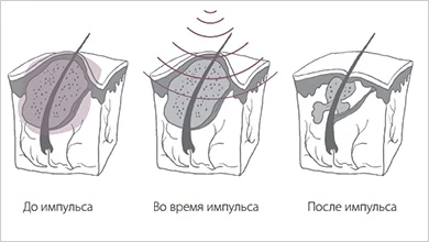 default imageset 727 image item - Лечение акне: как избавиться от проблемной кожи и не тратить годы впустую
